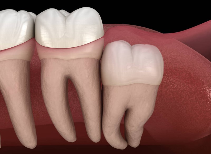 wisdom tooth removal