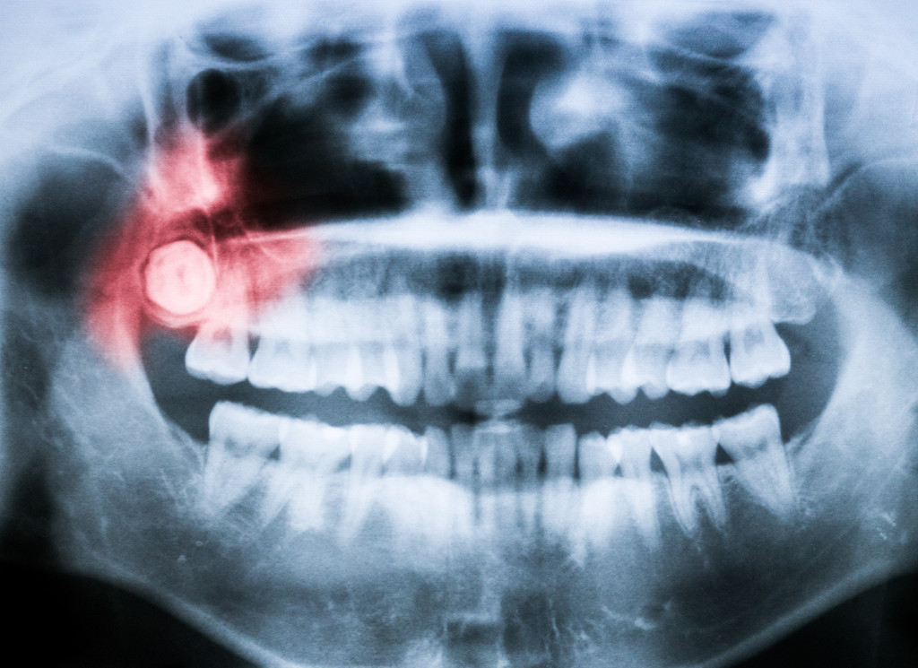 What Are Wisdom Teeth Removal in Perth, And Why Do They Need To Be Removed? faircopyright