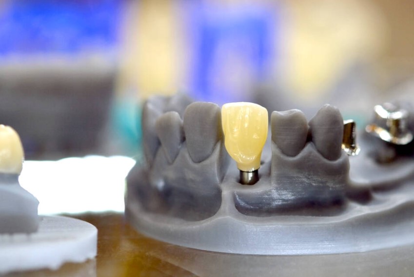 dental abutment